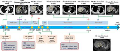 Lung Adenocarcinoma Harboring EGFR Kinase Domain Duplication (EGFR-KDD) Confers Sensitivity to Osimertinib and Nivolumab: A Case Report